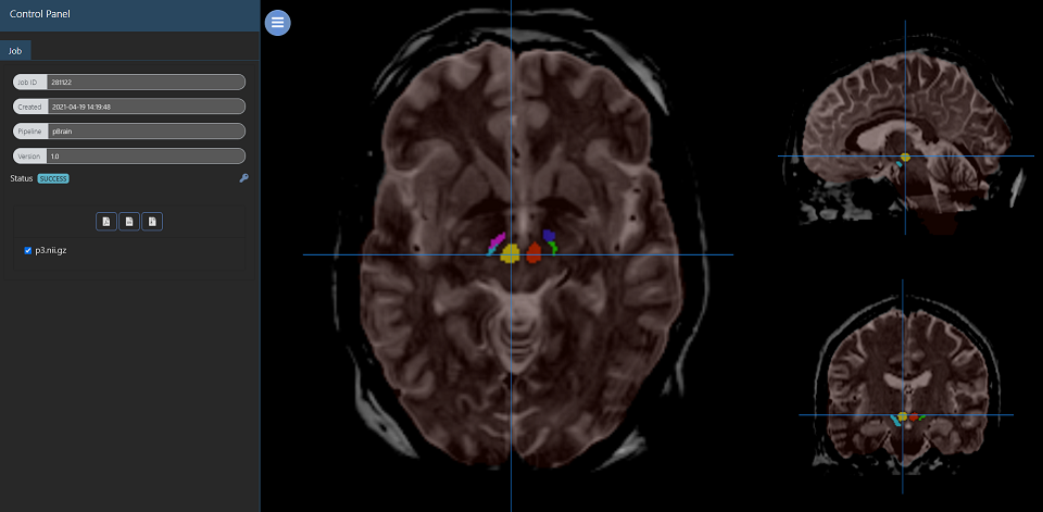 substantia nigra red nucleus